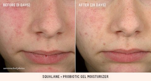 Probiotic Gel Moisturizer Before and After